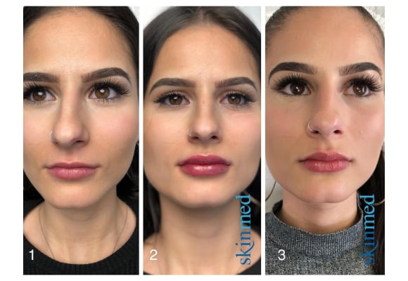 Lippen unterspritzen vorher nachher