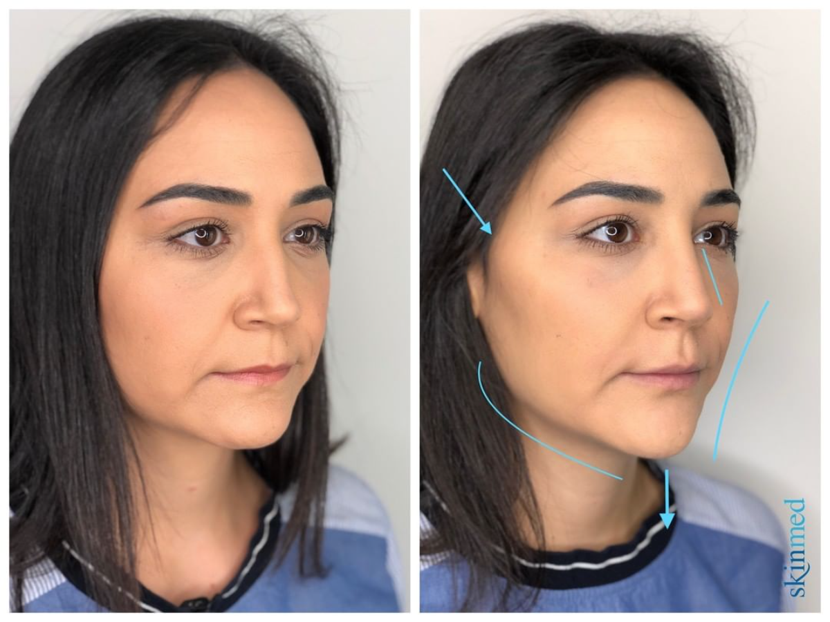 wangenknochen behandlung bei skinmed