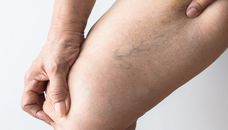 Venenheilkunde_Besenreiser_entfernen_Skinmed