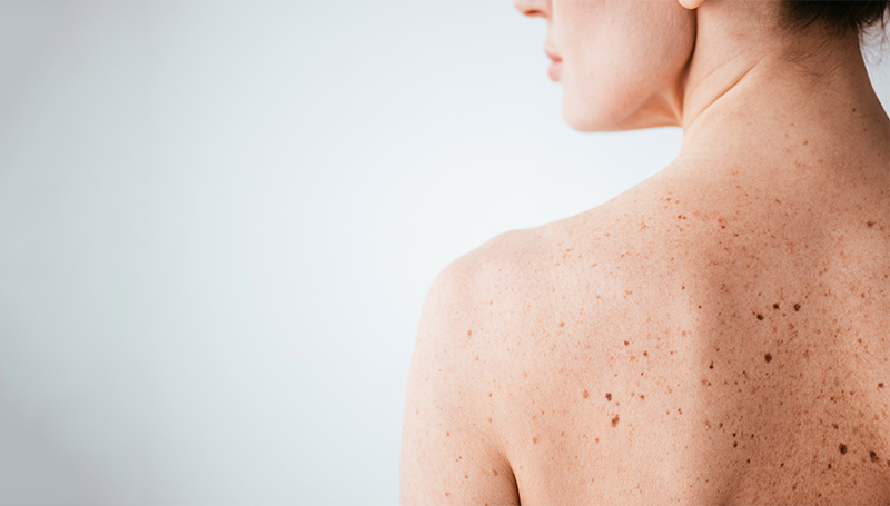 Skinmed_Muttermal_entfernen