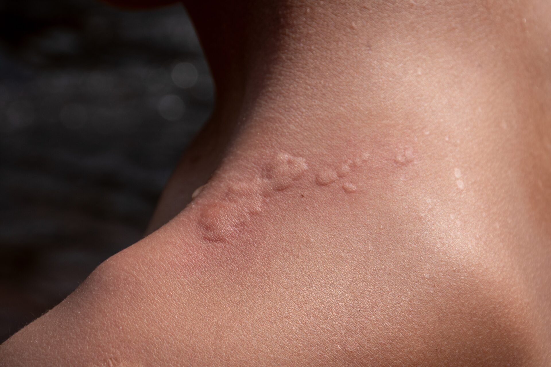 Nesselsucht Skinmed