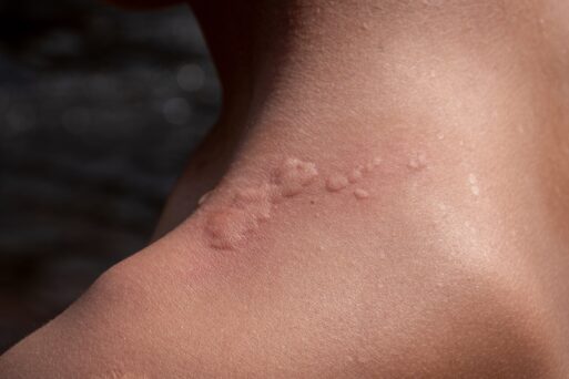 Nesselsucht Skinmed