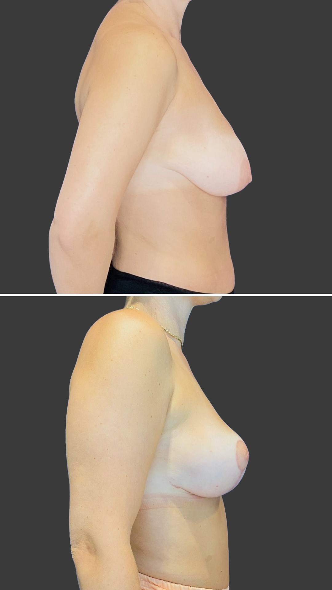 Skinmed_Dorota_Czerniak_Bruststraffung_2_web