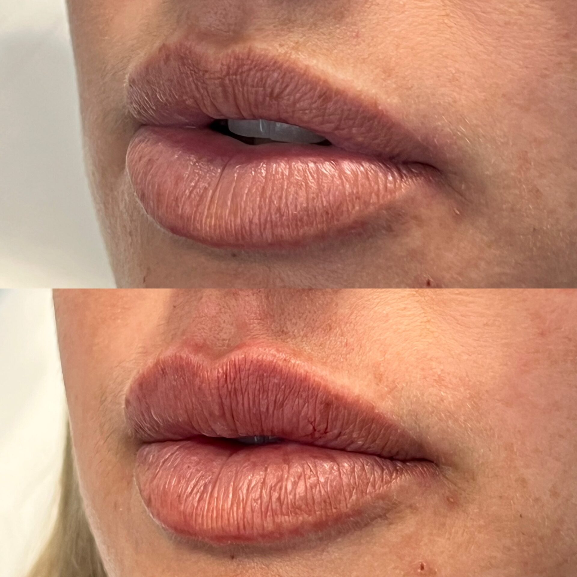 Skinmed_Lippen_aufspritzen_Felix_Bertram_1zu1Ratio