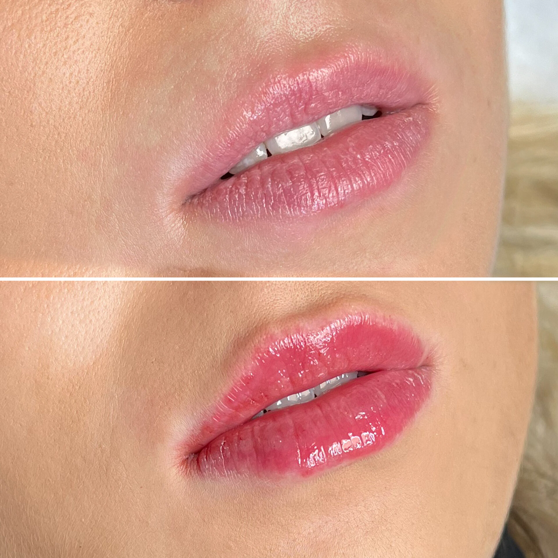 Skinmed_Lippen_aufspritzen_Malte_Schmelter