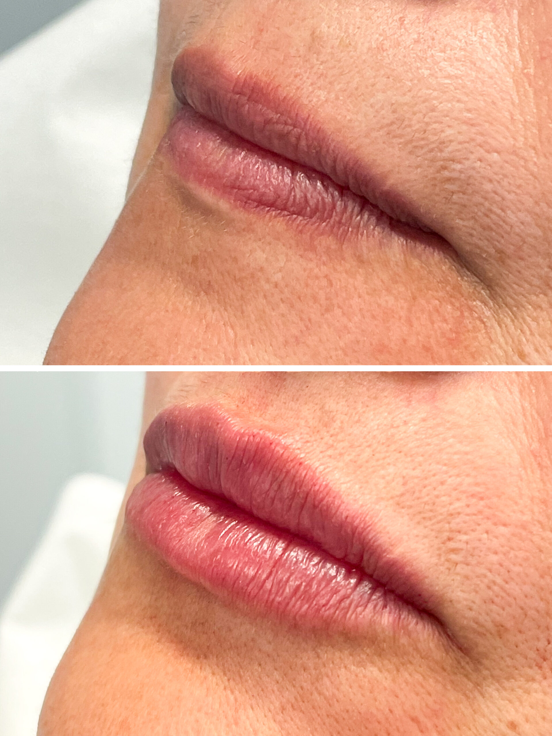 Skinmed_Lippen_aufspritzen_Milan-Barras_Vorher-Nachher