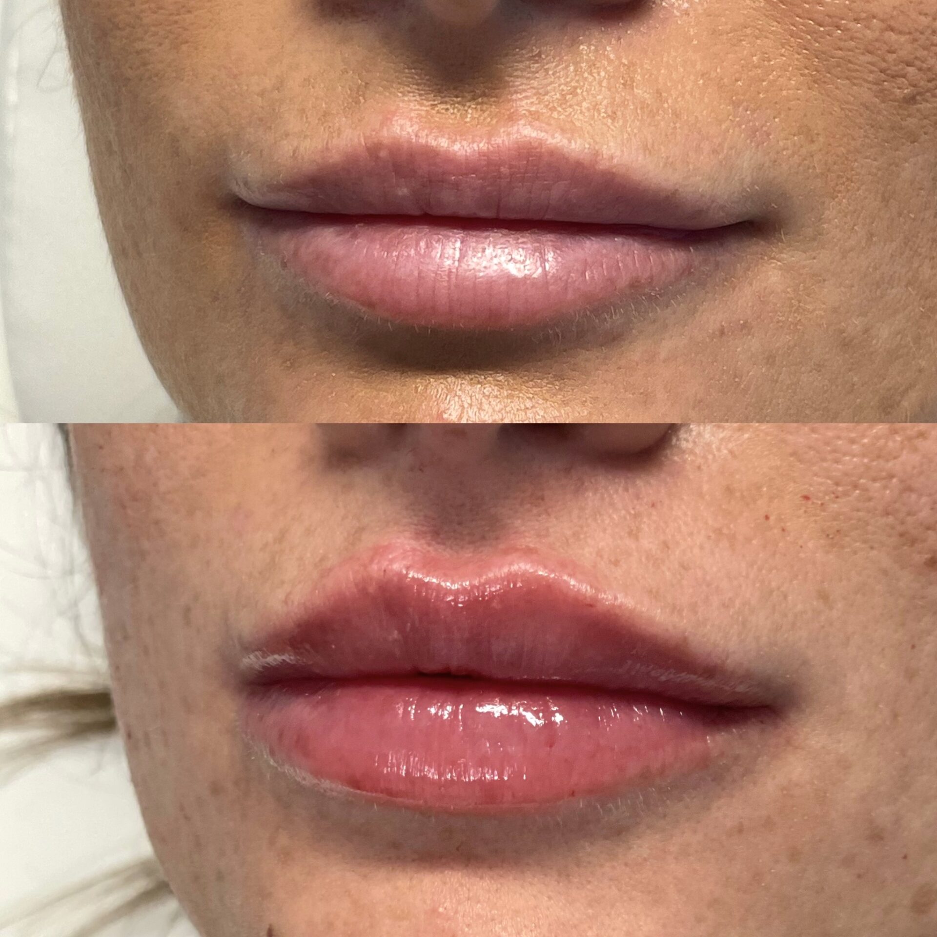 Skinmed_Lippen_aufspritzen_Milan_Barras