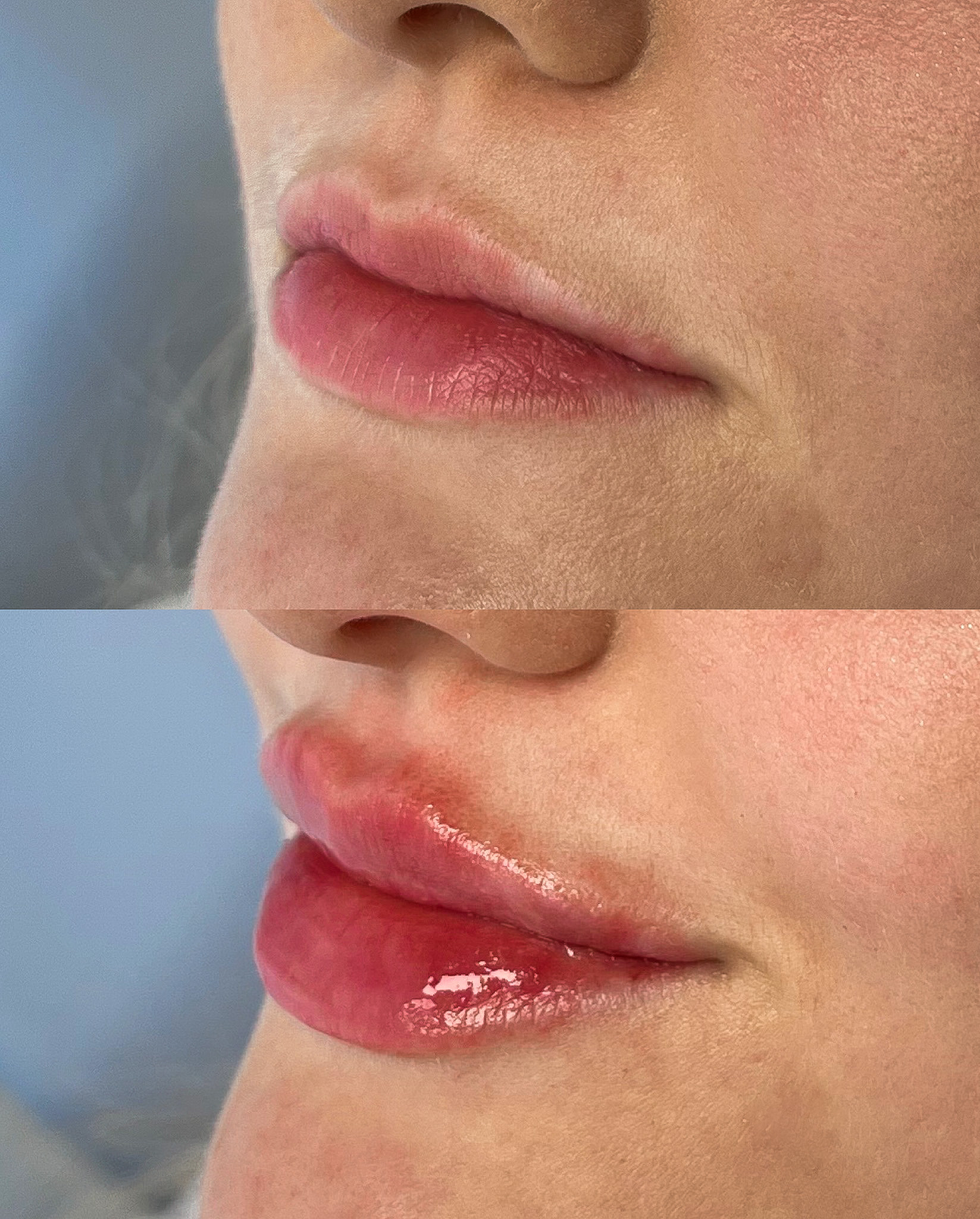 Skinmed_Lippen_unterspitzung_Malte_Schmelter