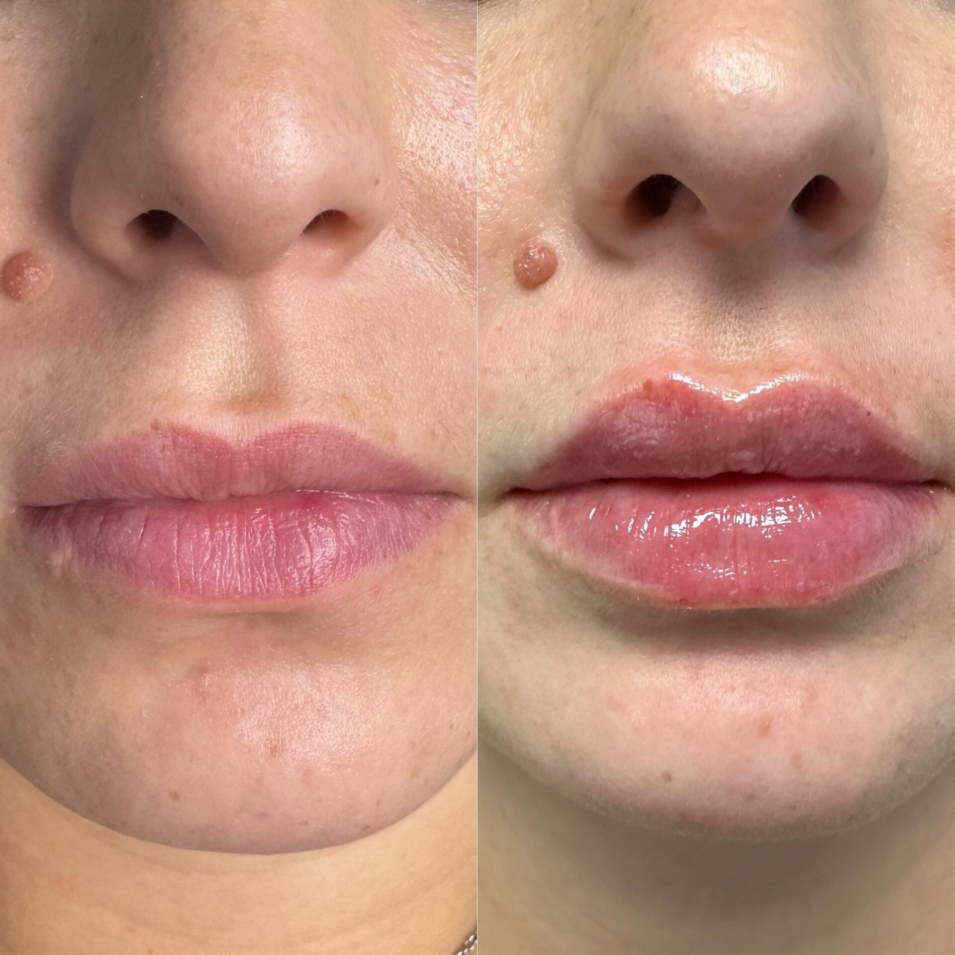 Skinmed_Lippen_unterspitzung_Sandra_Bingmann