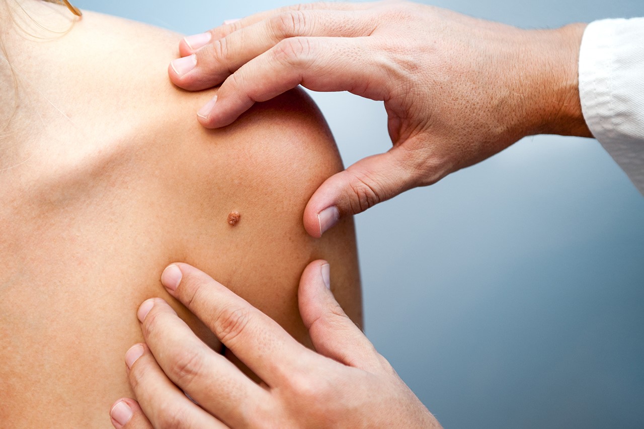 Skinmed Dermatologie Muttermal
