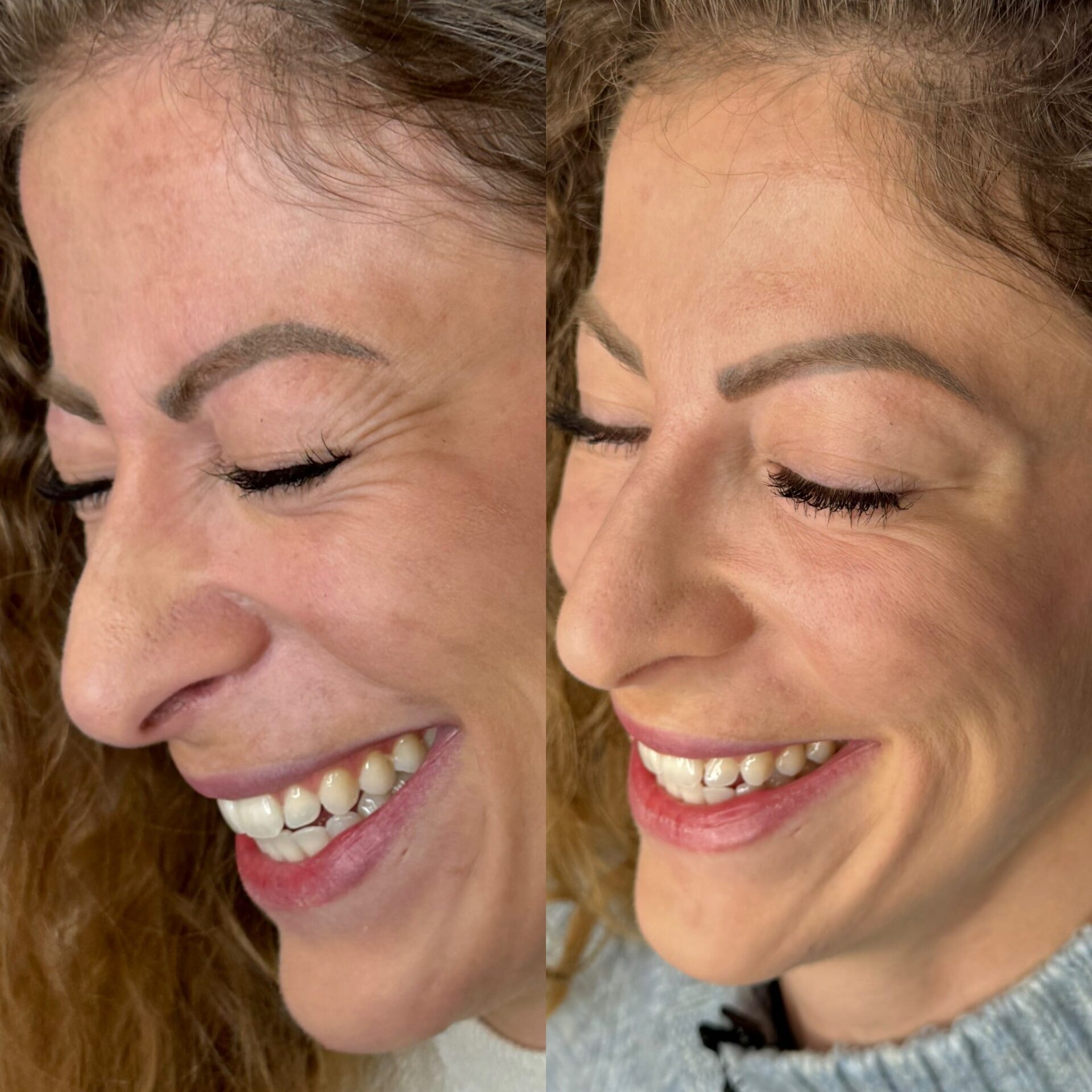 Skinmed_falten_unterspritzung_Malte_Schmelter