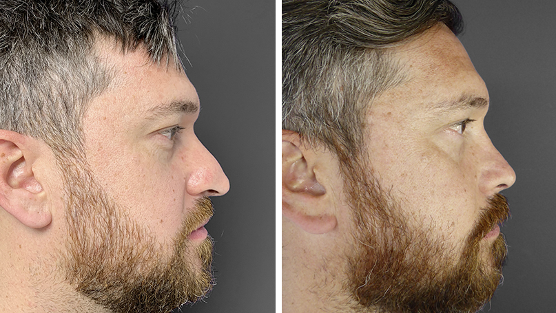 Nasenkorrektur Mann vorher nachher