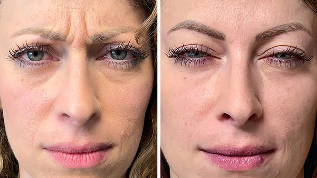 Zornesfalte Botox vorher nachher