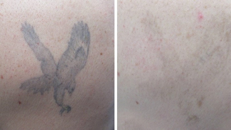 Tattoo Entfernung vorher nachher