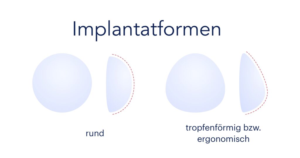 illustration vergleich von runden und tropfenförmigen Brust-Implantaten
